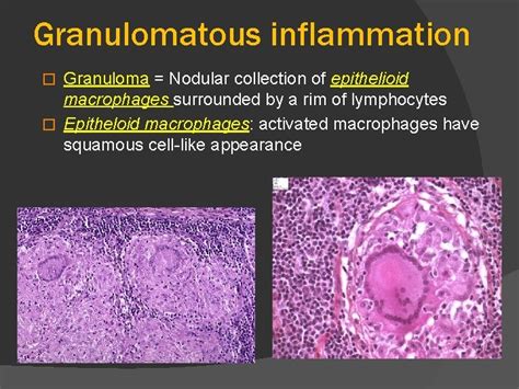Granulomatous Inflammation Foundation Block Pathology 2012 Dr Maha