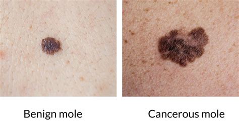 Pictures Of Cancerous Moles Early Stage Cancerous Moles Images Pictures Of Skin Moles