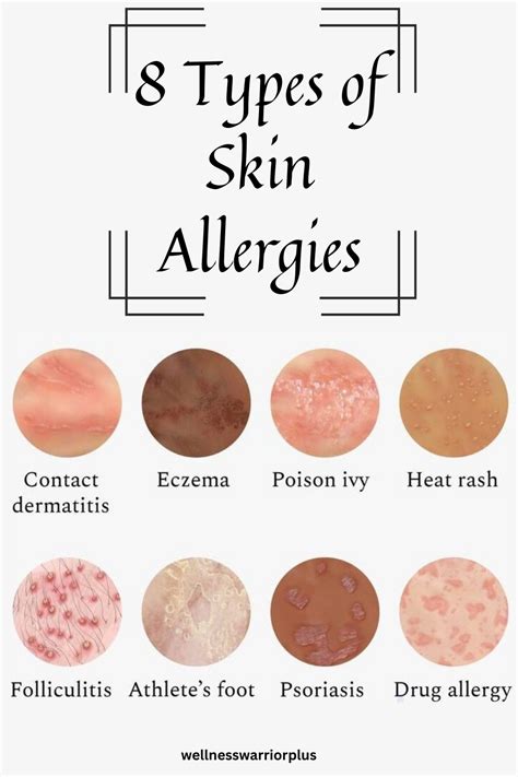 8 Types Of Skin Allergies Skin Allergies Allergies Health Tips