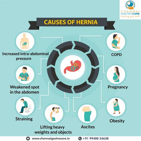 Be Aware Of The Causes Of Hernia Avail Free Hernia Screening At