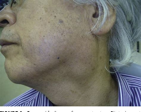 A Case Of Squamous Cell Carcinoma Arising From Branchial Cleft Cyst