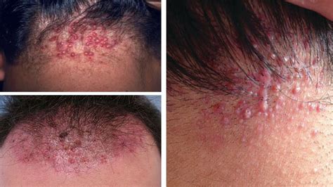 How To Treat Folliculitis On Scalp Naturally 8 Best Home Treatments