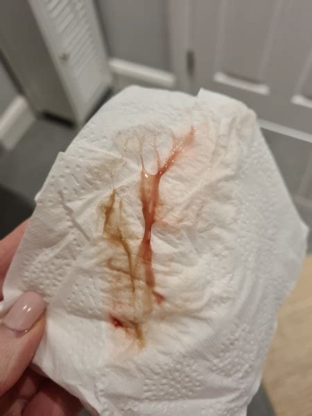 Stringy Discharge And Spotting Tmi Picture Included Mumsnet
