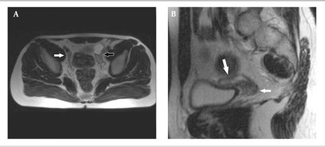figure 1 from magnetic resonance imaging findings of ovotesticular disorder of sex development