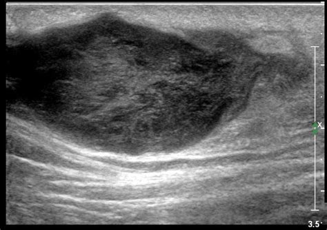 Sebaceous Cyst Ultrasound Radiology Sonography