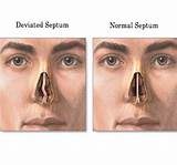 Deviated Septum Recovery Images