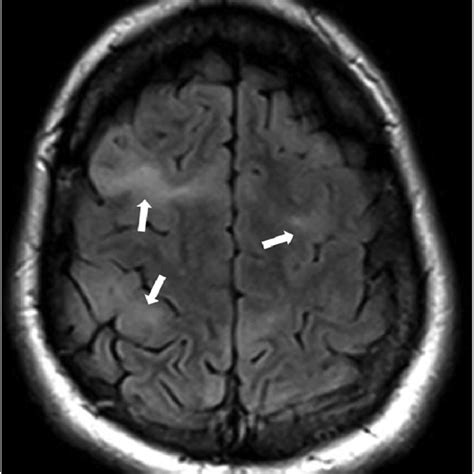 Lymphangioleiomyomatosis Lam In A Patient With Tuberous Sclerosis A