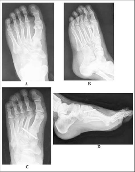 A Female Patient With Second Tarsometatarsal Joint Fracture Dislocation