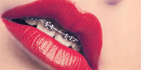 why adult braces are becoming more popular