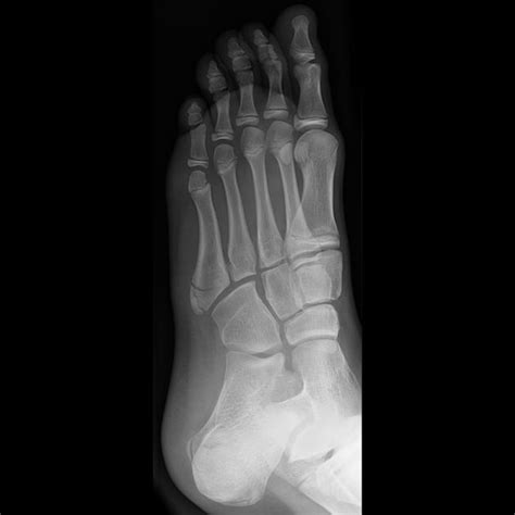 Base Of 5th Metatarsal Fracture And Apophysis Radiology Case