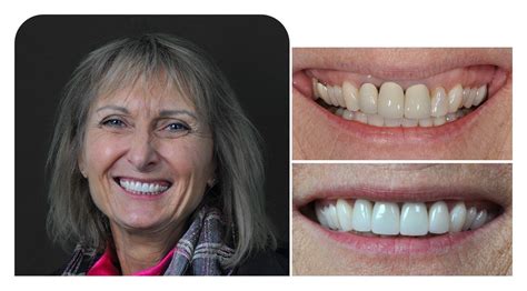 Cosmetic Dentistry Facial Profile Hot Nude Comments