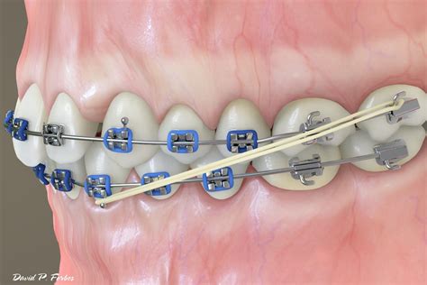 ~ the vermette ortho team. Treatment Auxillaries: Elastics (rubber bands) - Forbes ...