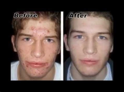 Using a chemical peel to get rid of acne, treat acne scars or achieve ageless skin requires repeated use. Best Chemical Peel for Acne Scars,Melasma,Wrinkles... VI ...