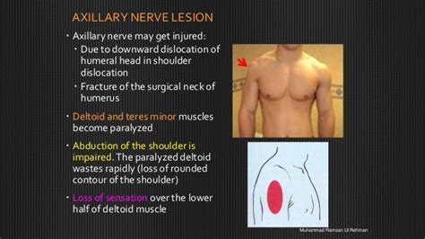 Axillary Nerve Dysfunction