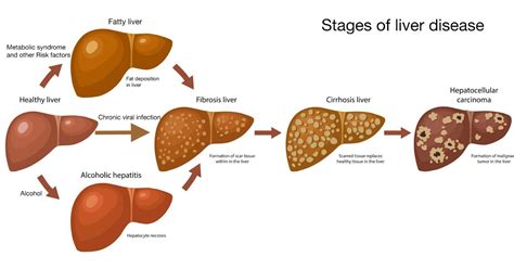 Cirrhosis Of Liver By Dr Vishal Khurana Senior Gastroenterologist