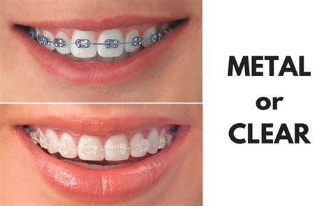 Ask Your Ennis Dentist Should I Get Metal Or Clear Braces Ennis