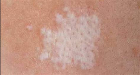 10 Reasons Of White Patches Or Spots On Your Skin Read Health Related