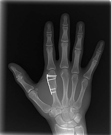 Right Hand | These are recent x-rays of various broken bones… | Flickr