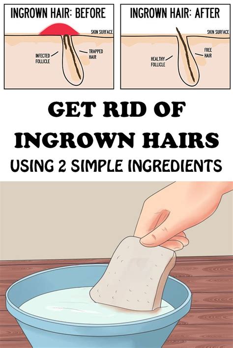 Regular ingrown hairs that don't go away on their own may also require prescriptions, like a topical retinoid to increase cell turnover, a steroid cream to reduce inflammation, or medical removal. Get Rid of Ingrown Hairs Using 2 Simple Ingredients ...