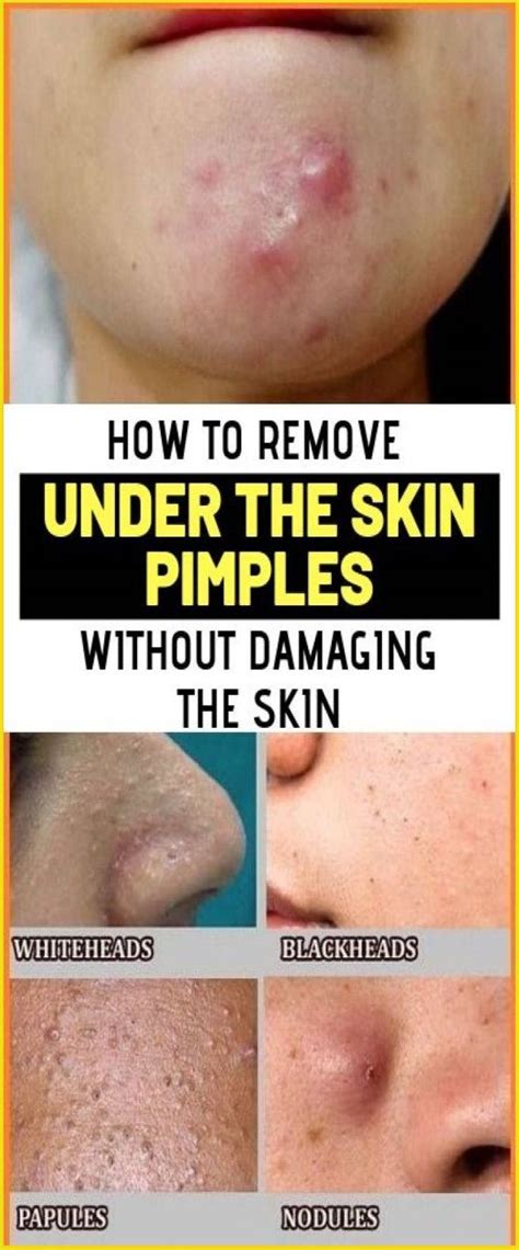 Baryban Pimples Under The Skin Pimples Skin Health