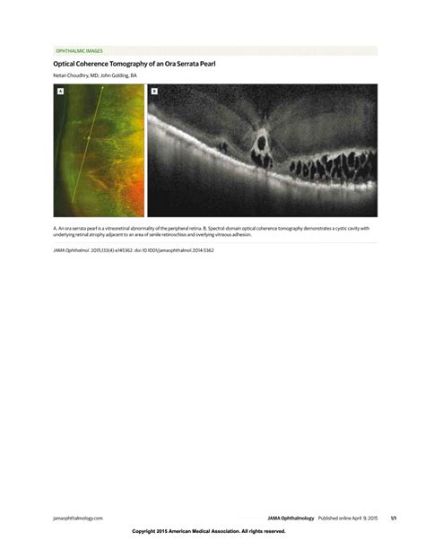 Optical Coherence Tomography Of An Ora Serrata Pearl Ophthalmic