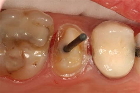 Cementation after 24 hours and. Pęknięty ząb na szybko! - Zdrowie