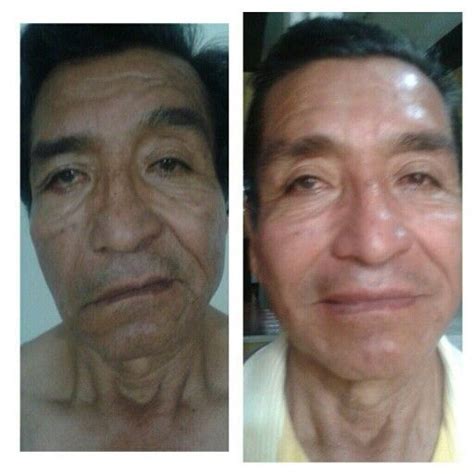 Before And After A Stroke Using The Nuskin Spa Facial Machine Facial