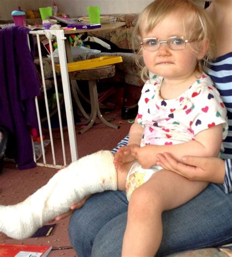 Musgrove Park Hospital Toddler Who Had Broken Her Leg Sent Home With