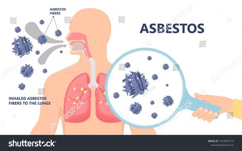 Im Genes De Asbestosis Im Genes Fotos Y Vectores De Stock Shutterstock