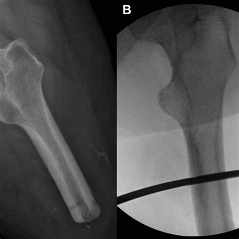 A Preoperative Anteroposterior Radiograph Of Surgical Left Hip And