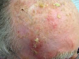Actinic keratosis is a precancerous lesion that is commonly seen in the elderly patient and requires treatment. Four Treatments for Actinic Keratosis