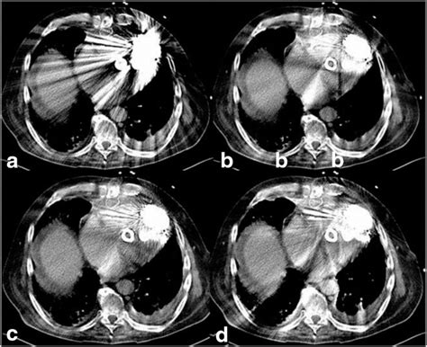 Lvad Chest Ct Reconstruction With Filtered Back Projection And Metal
