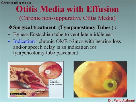 Chronic Otitis Media Dr Farid Alzhrani Assistant Professor