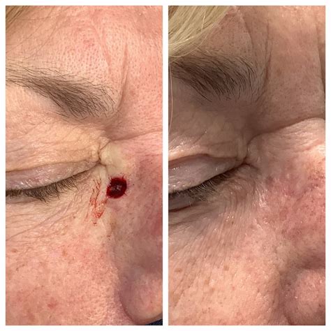 Eyelid Reconstructive Surgery Before And After