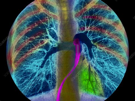 Coloured Angiogram Showing The Pulmonary Arteries Stock Image P Science Photo Library