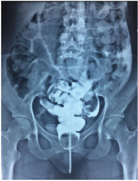 Rectal Perforation After Anal Intercourse