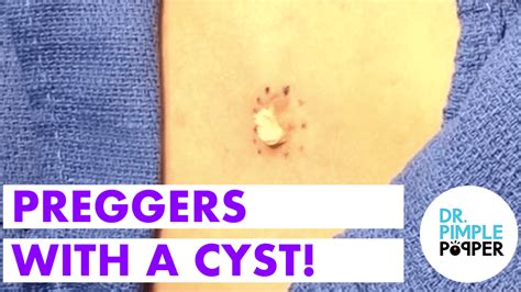 When Youre Preggers With A Cyst Cystactular Cysts Dr Pimple Popper