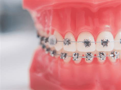 Dental Braces Invisalign Braces Walnut Grove And Langley