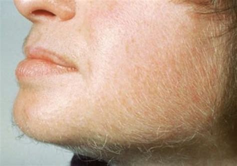 Hirsutism Dermatology Conditions And Treatments