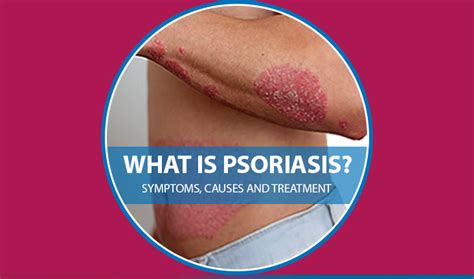 Psoriasis Symptoms Causes And Treatment Vps Lakeshore