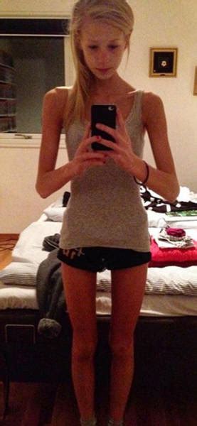 Anorexic Girl Who Was Given Only Days To Live Fights Her