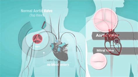understanding heart murmurs aortic and mitral valve problems youtube