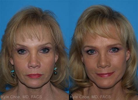 Facelift Virginia Beach Facial Rejuvenation Norfolk