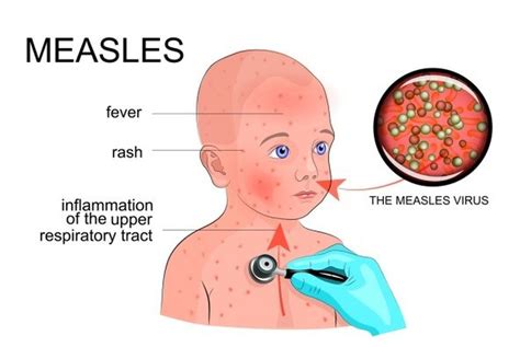 What Is Measles