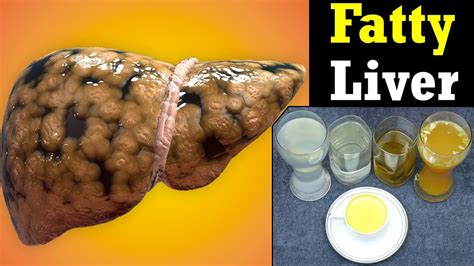 Easy Remedies To Treat Fatty Liver Naturally At Home Health And