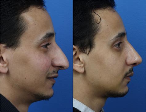 Middle Eastern Rhinoplasty New York City Ny Dr Philip Miller