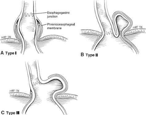 Paraesophageal Hernia Types
