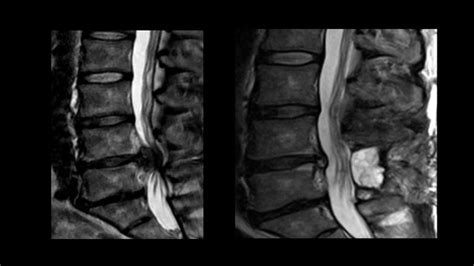 Cauda Equina Syndrome With Normal Mri Imaging The Meta Pictures