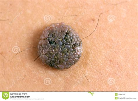 Close Up Photo Of A Mole On The Skin Royalty Free Stock Photos Image