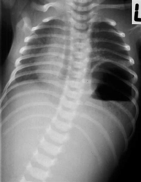 Plain Radiograph Of Chest And Abdomen Showing Left Diaphragmatic